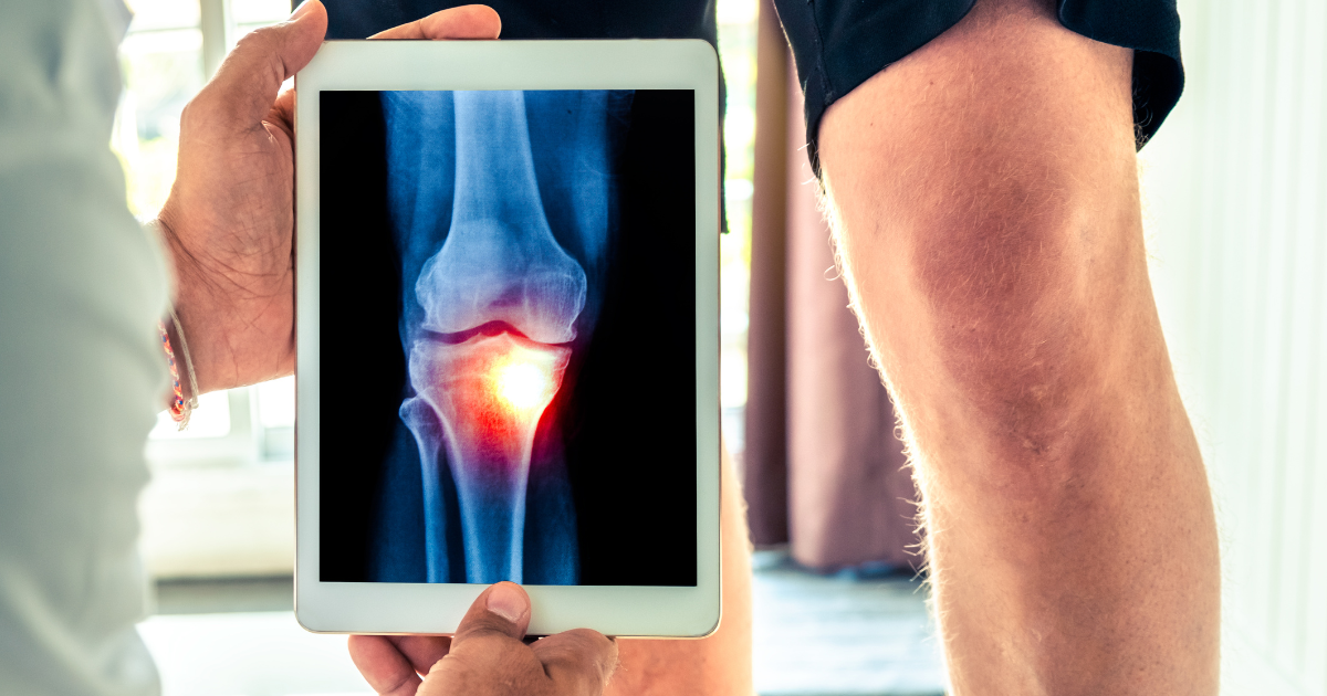 artrosi del ginocchio - ginocchio di un uomo in pantaloncini di fianco ad un ipad con immagine di un rx al ginocchio